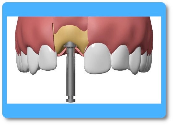 implant dentaire Pont à Mousson